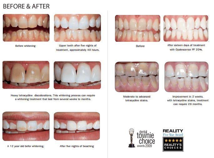 Ultradent Opalescence PF %16 Ev Tipi Diş Beyazlatma Seti